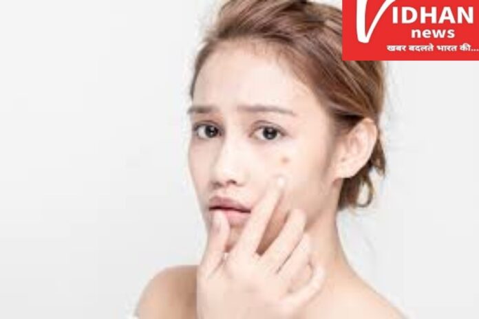 Pimples Marks