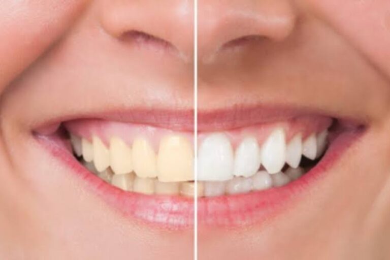 Teeth Whitening Tips: शर्मिंदगी का कारण बन सकता है दांतों का पीलापन, इस तरह दूर करे दांतो का पीलापन