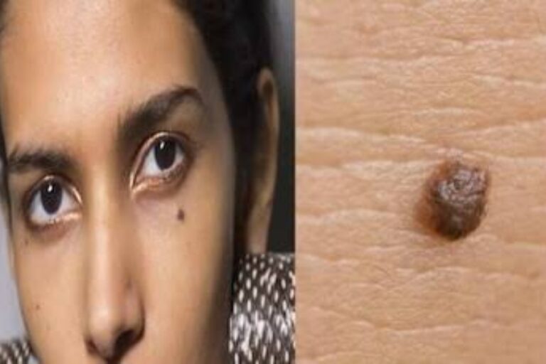 Wart Removal Tips: अनचाहे मस्सो से छुटकारा पाने के लिए करें ये काम, जड़ से खत्म होगी यह समस्या