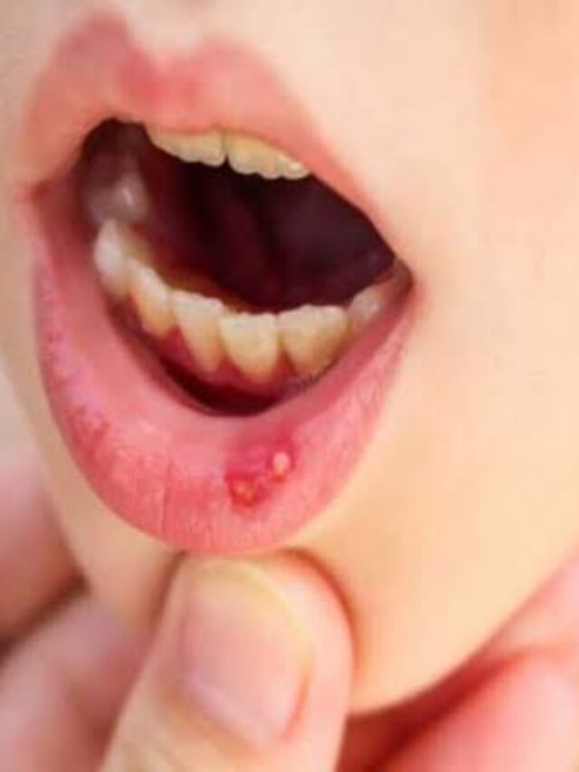 Tongue Ulcer Remedy