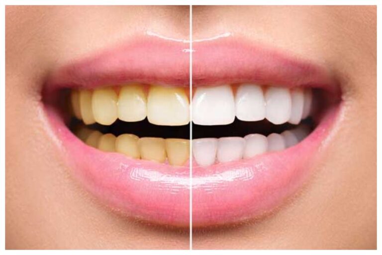 Teeth Whitening Tips: दादी-नानी के नुस्खों से मोती से चमक जाएंगे दांत, अब खुलकर हसें, बदबू भी छूमंतर