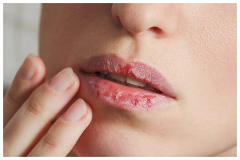 Cracked Lips Tips: होंठ फटने की दिक्कत हो तो इन घरेलू नुस्खों को अपनाकर बनाएं बिल्कुल मुलायम