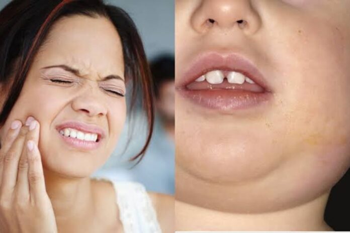 Mumps Symptoms & Treatment