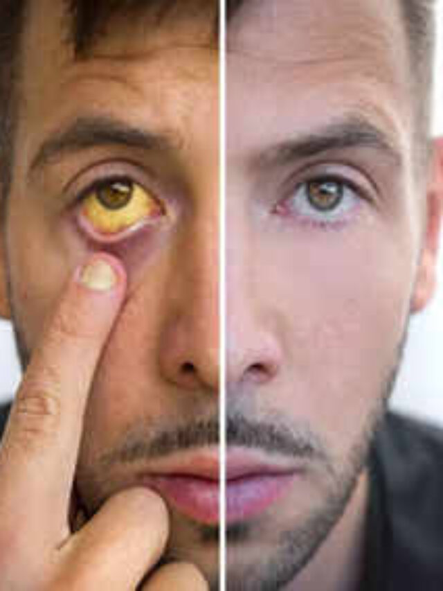 Jaundice Disease