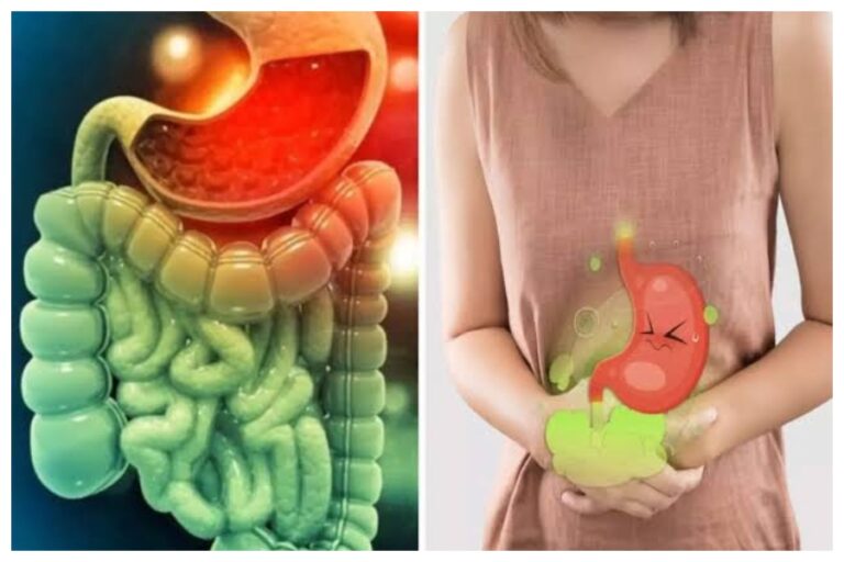 Acidity Problem: अगर पेट में लगातार बना रही है गैस तो ना करें नजरअंदाज, हो सकती है यह खतरनाक बीमारी