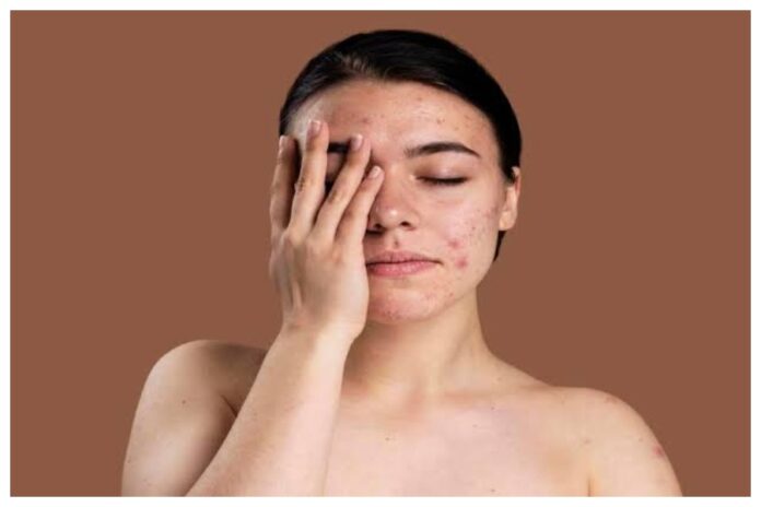 Pimples On Forehead In Summer
