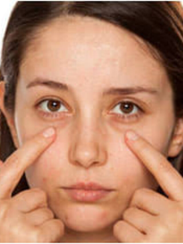 Dark Circles Remedies