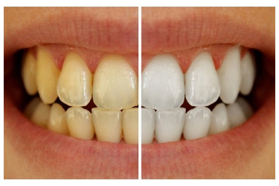 Yellow Teeth Cleaning
