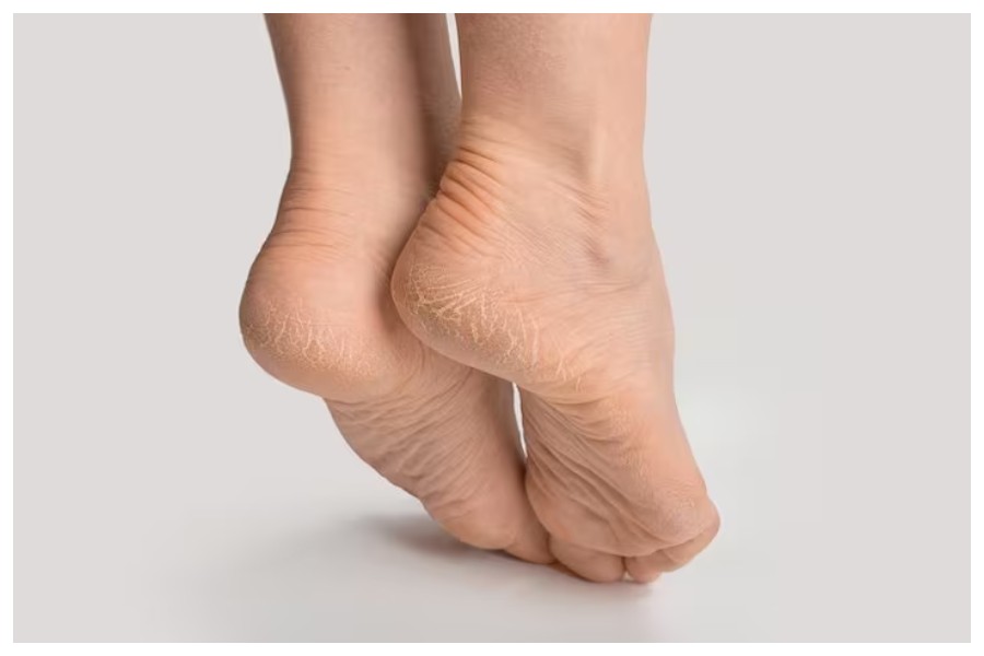 cracked heels