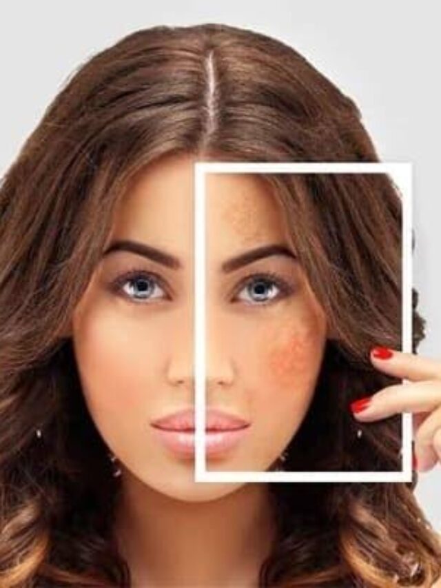 Pigmentation Tips
