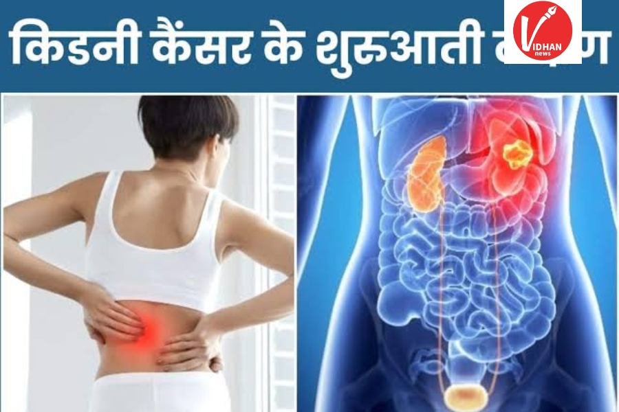 Kidney Cancer Kidney Cancer