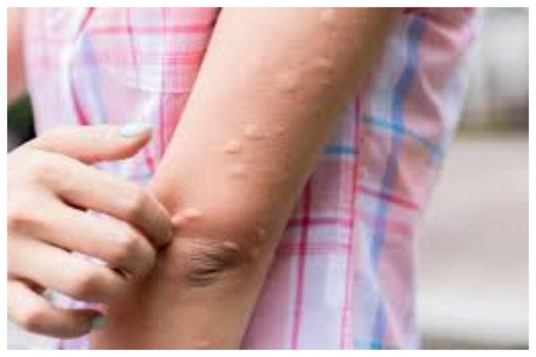 Mosquitoes Biting Reasons: क्या आपको दूसरों से ज्यादा काटते हैं मच्छर? ये 5 वजहें हो सकती हैं कारण