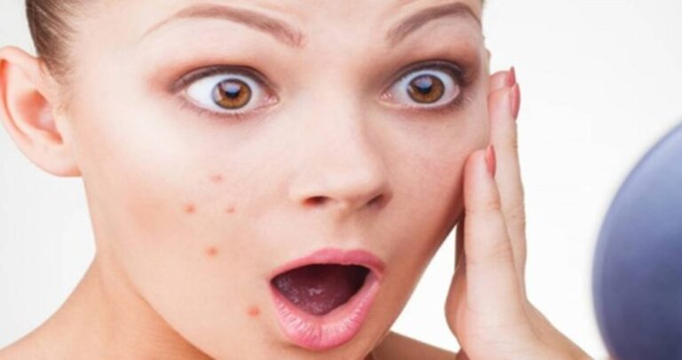 Pimples on Face