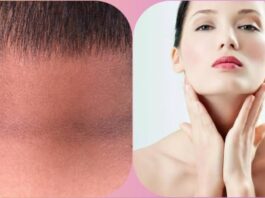 Dark Neck Treatment
