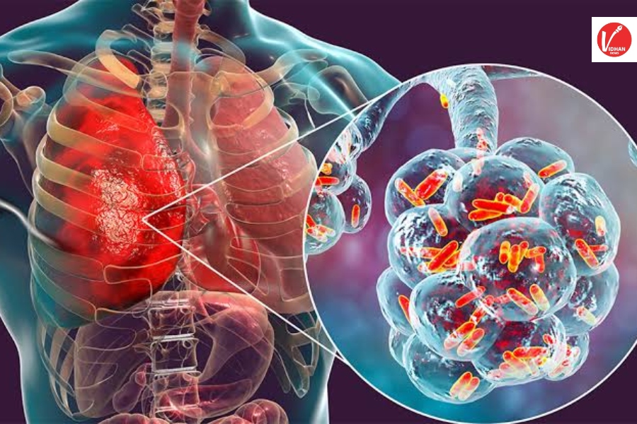 Lung Cancer Lung Cancer