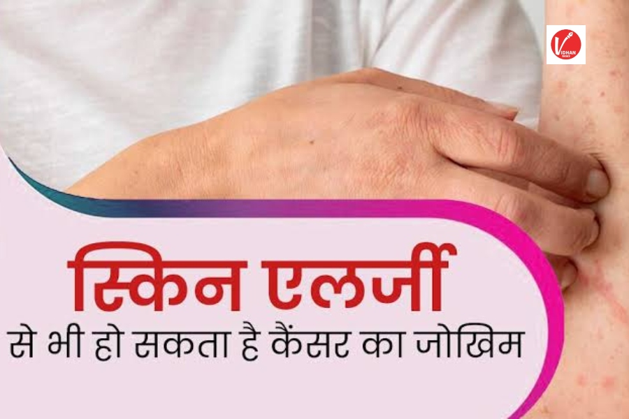 Skin Cancer Risks Skin Cancer Risks