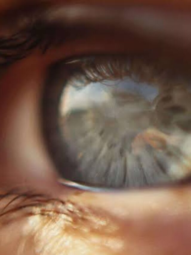 Cataract Problem: