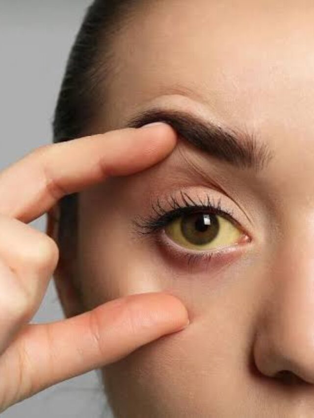 Jaundice Disease
