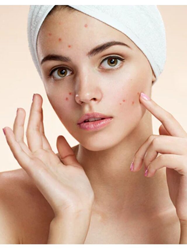 pimples1