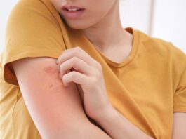 Home Remedies For Ringworm