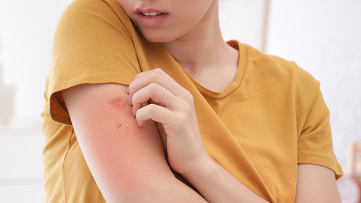 Home Remedies For Ringworm Home Remedies For Ringworm