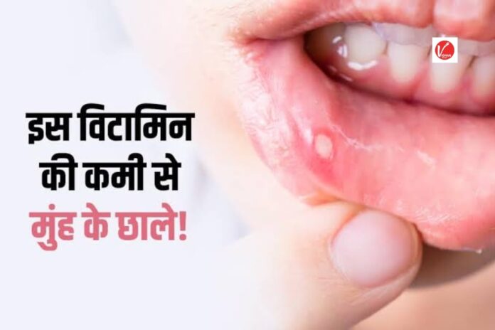Vitamin B12 Deficiency