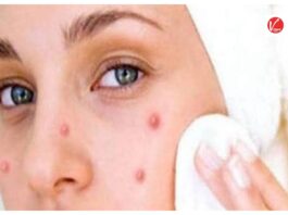 Monsoon Skin Care Tips