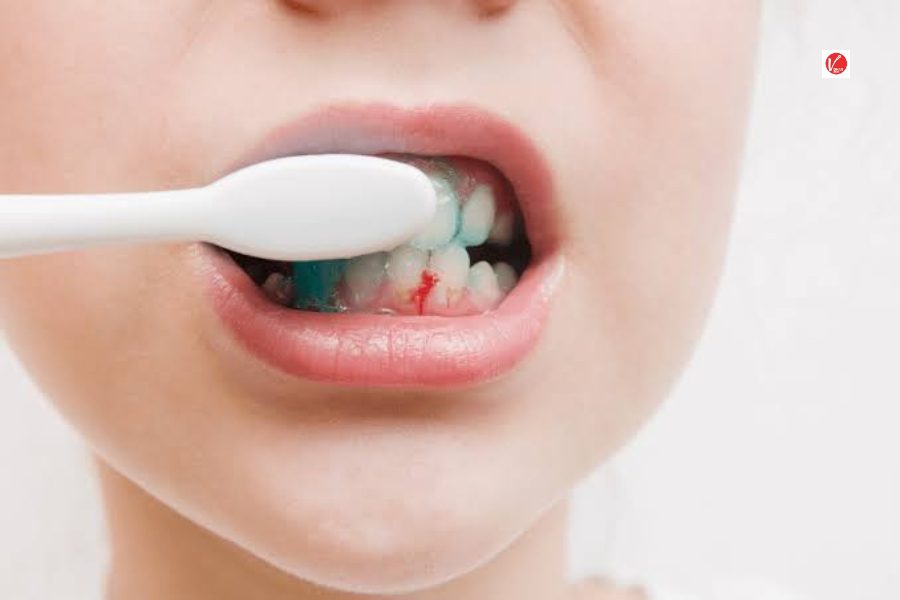 Gum Bleeding Gum Bleeding