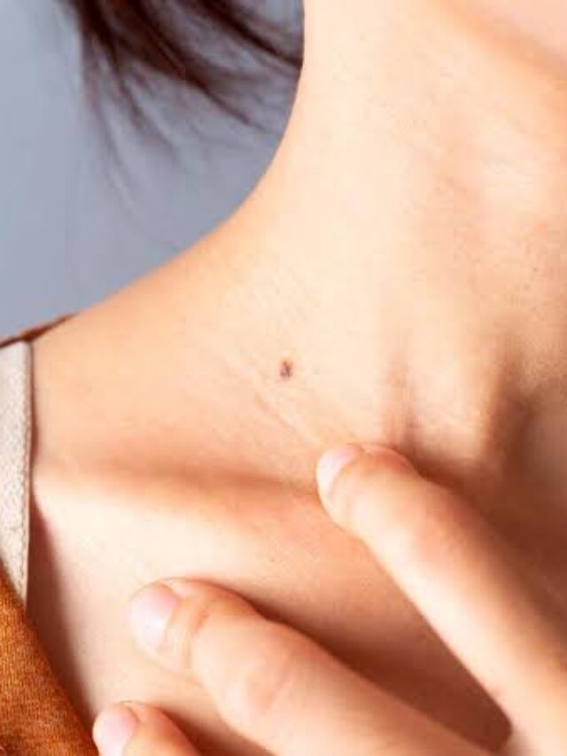 Skin Cancer Symptoms