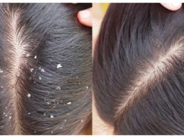 Dandruff Home Remedies