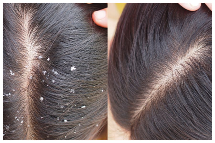 Dandruff Home Remedies