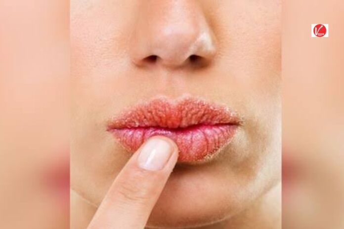 Winter Lips Care Tips