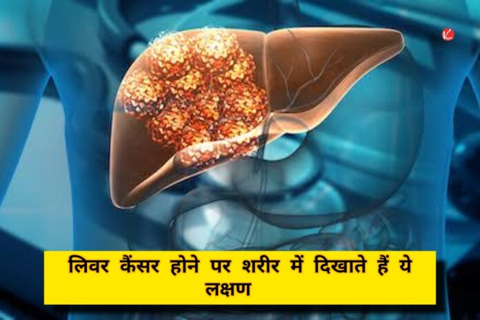 Liver Cancer Symptoms: