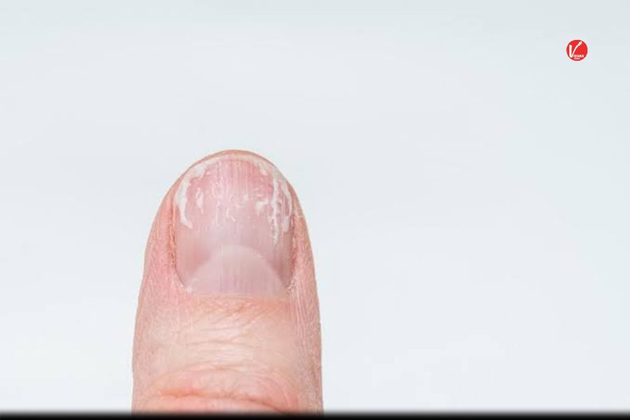 Nail Cancer Nail Cancer