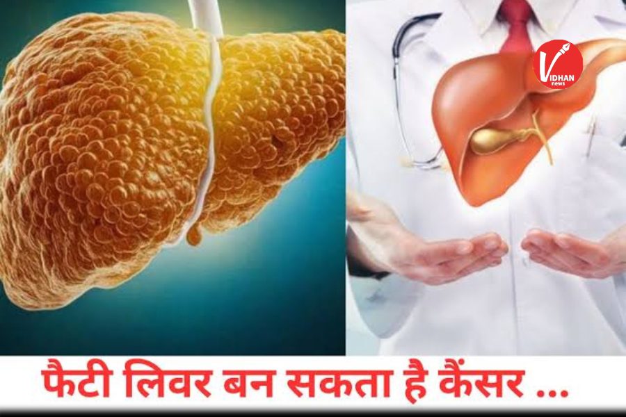 Fatty Liver Fatty Liver