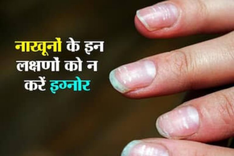 Nail Disease Symptoms: नाखून में दिखने वाले ये लक्षण हो सकते हैं गंभीर बीमारी के संकेत, समय रहते हो जाएं सावधान