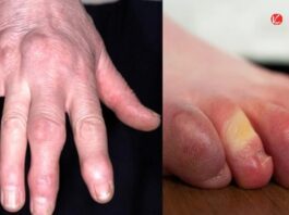 Fingers swelling in winter