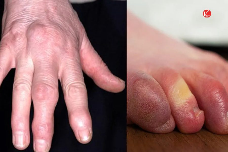 Fingers swelling in winter Fingers swelling in winter